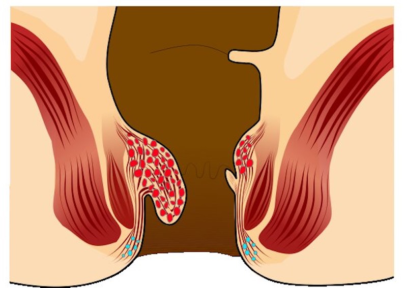 Real Experience - How do I get rid of Bleeding Piles