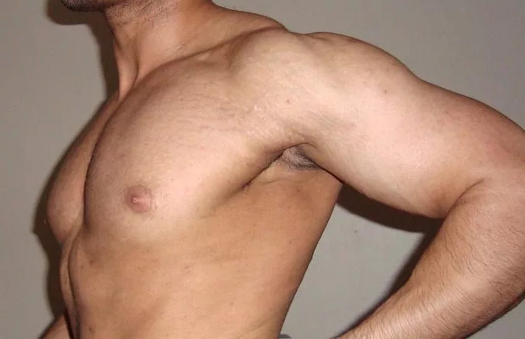 stretch marks