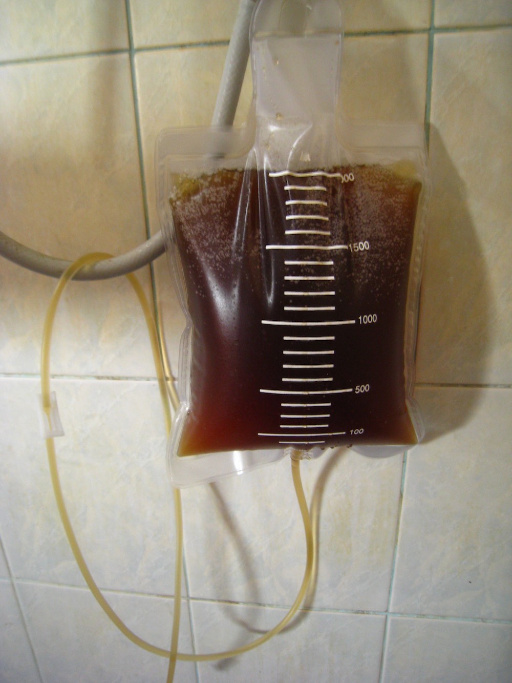 coffee enema