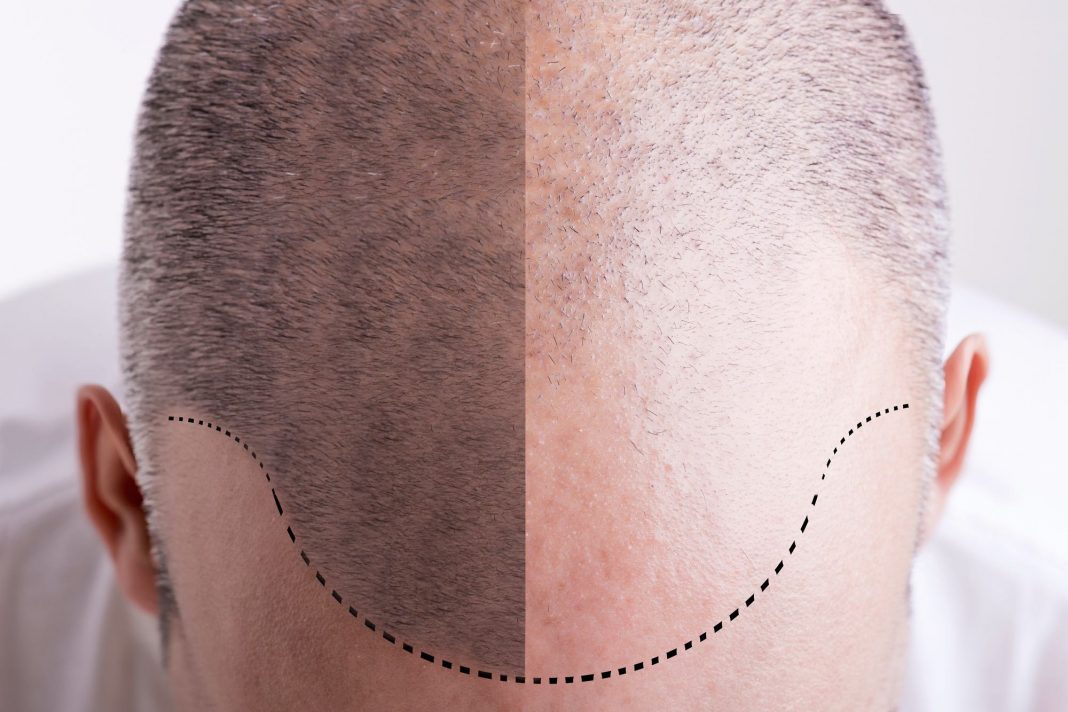 How Long Does Scalp Micropigmentation Last on Average