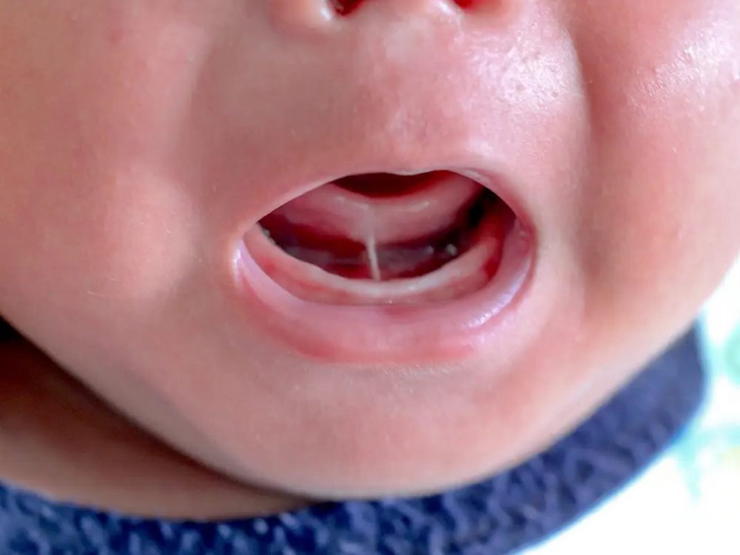 TONGUE TIE