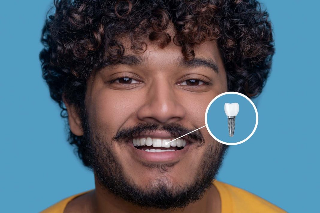 Guide to Dental Implant Maintenance